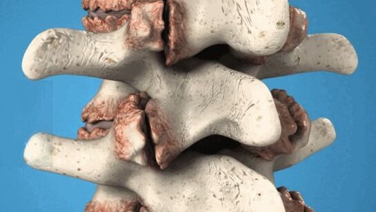 Osteophyten der Wirbel - pathologische Wachstum, die Nerven und Blutgefäße schädigen