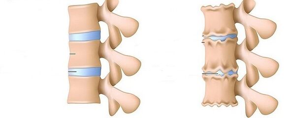 Gesunde Wirbelsäule und Osteochondrose