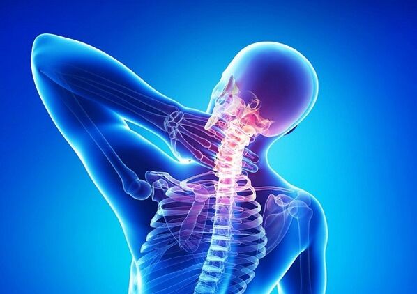 Schmerzen in der Halswirbelsäule mit Osteochondrose