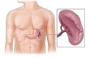 Pathologie der Milz als Ursache für Schmerzen unter dem linken Schulterblatt