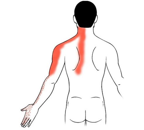 zervikale Osteochondrose als Ursache für Schmerzen in den Fingergelenken