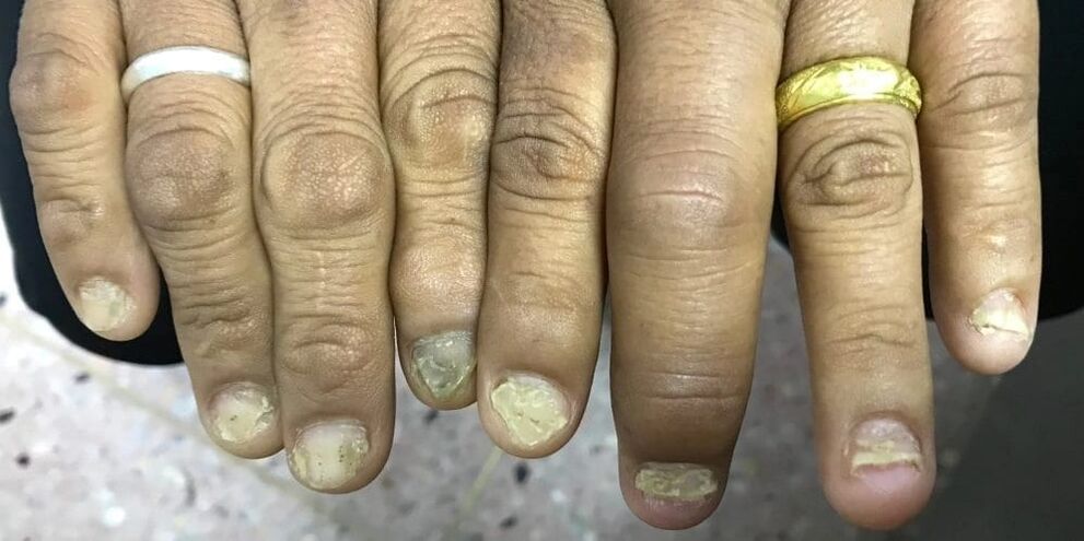 Eine Schwellung der Finger und eine Verformung der Nagelplatte können auf die Entwicklung einer Psoriasis-Arthritis hinweisen