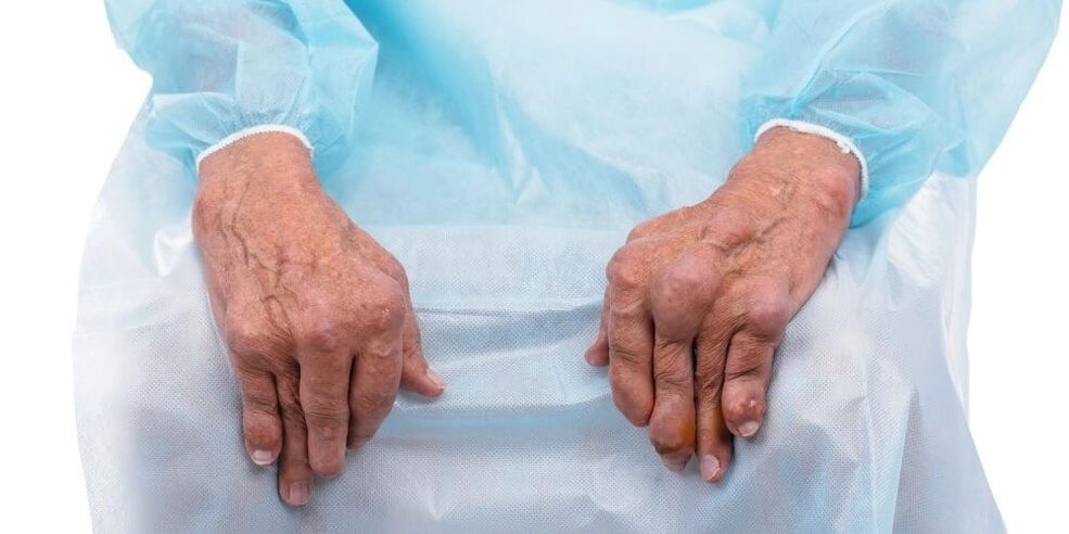 Infektiöse Arthritis ist eine Krankheit mit ständigen Schmerzen und Veränderungen in den Fingergelenken.