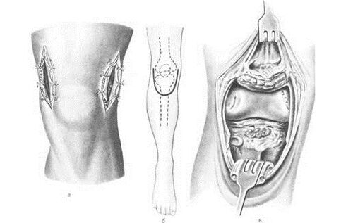 Arthrotomieoperation bei Arthrose