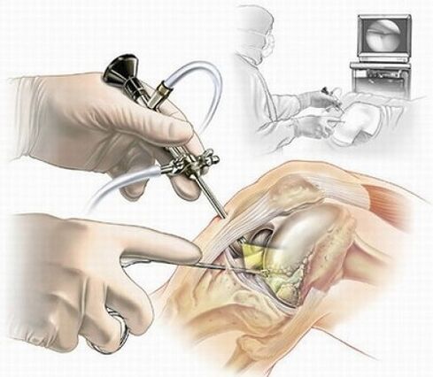 Kniearthroskopie bei Arthrose