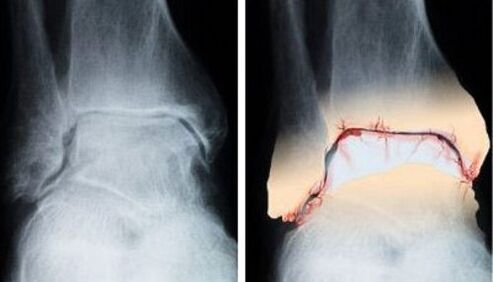 gesundes und arthrotisches Gelenk